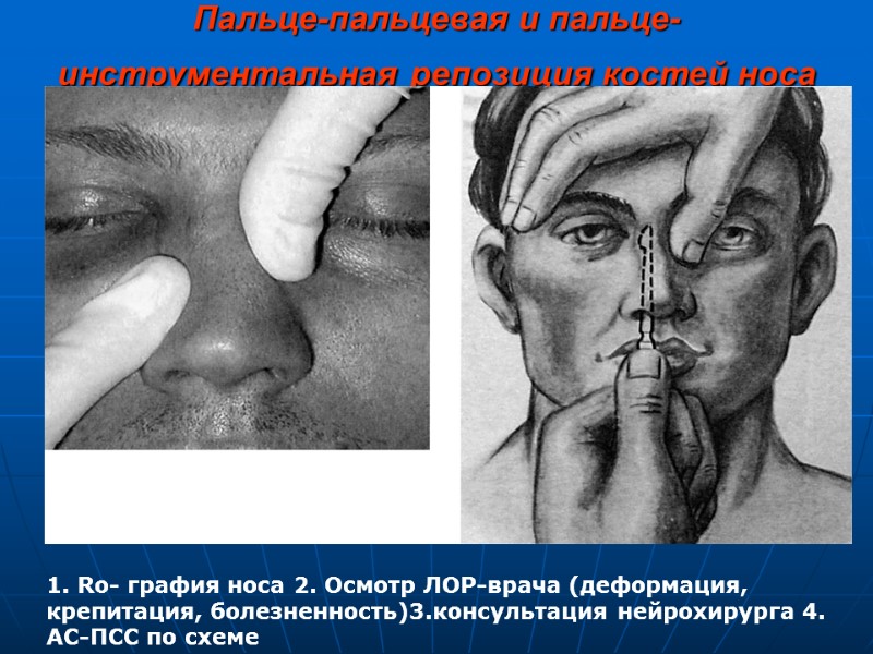Пальце-пальцевая и пальце-инструментальная репозиция костей носа  1. Ro- графия носа 2. Осмотр ЛОР-врача